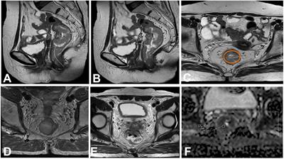 Extramural vascular invasion nomogram before radical resection of rectal cancer based on magnetic resonance imaging